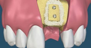 Cấy ghép xương răng – Tại sao cần thực hiện kỹ thuật này