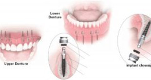 Cách tiết kiệm chi phí khi cấy ghép răng Implant