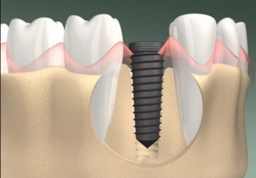 Cấy ghép răng Implant có ảnh hưởng gì không?
