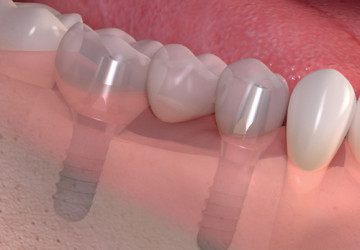 Công nghệ làm răng Implant tại Hà Nội