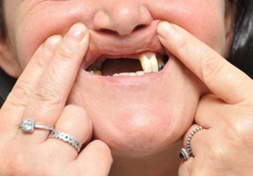 Trồng răng implant có đau không? Chuyên gia tư vấn