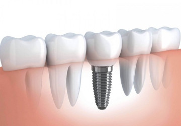 Giúp bạn hiểu rõ: Cắm răng implant là gì?