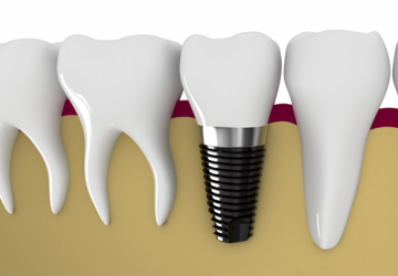 Trồng răng Implant giá bao nhiêu – Chi phí cụ thể cho từng dòng trụ Implant