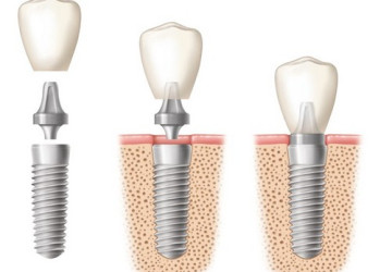 Địa chỉ trồng răng implant nào uy tín tại hà nội?