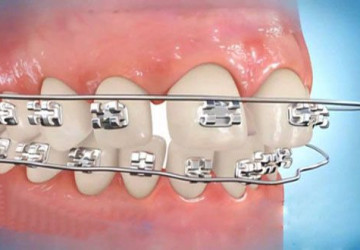 Bạn đã hiểu đúng “niềng răng để làm gì?”- Kiến thức nha khoa