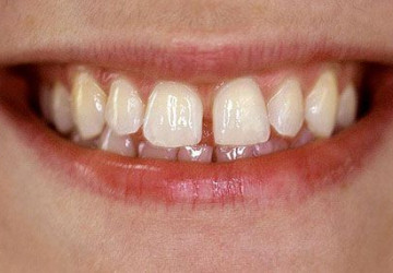 Sự thật thì răng thưa có nên bọc sứ không?