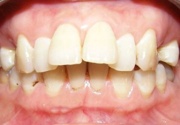 Răng hô là gì? Cách nhận biết răng hô chuẩn không cần chỉnh