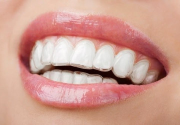 Làm sao để chọn được loại niềng răng tốt nhất và phù hợp nhất