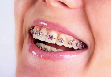 Chia sẻ phương pháp chỉnh hình răng thưa hiệu quả nhất hiện nay