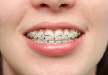 Top những cách chữa răng vẩu hiệu quả nhất hiện nay trên thế giới