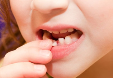 Bí quyết >>> Bạn có biết răng lung lay làm sao cho chắc lại không?