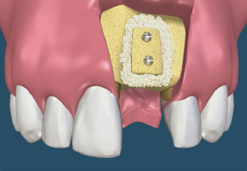 Vì sao nên ghép xương răng? Câu trả lời không thể shock hơn!