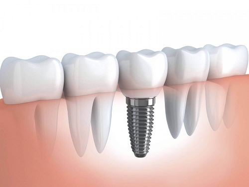 Làm răng implant có đau không thưa bác sĩ