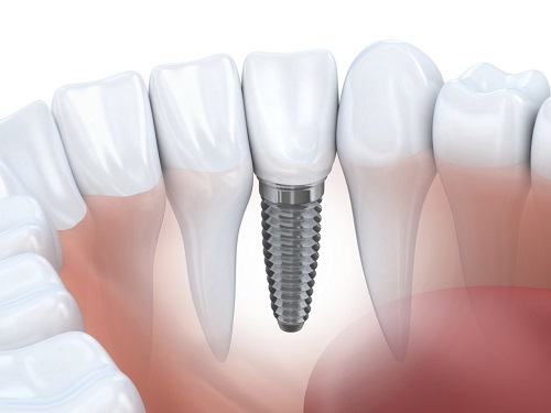 nên làm cầu răng hay implant 2