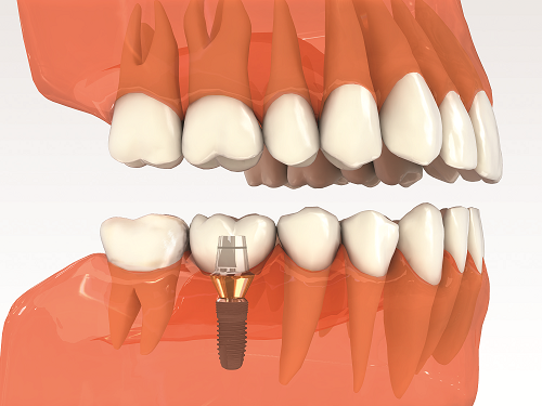 Trồng răng implant mất bao lâu