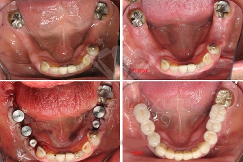 Quy trình trồng răng implant được thực hiện như thế nào 3