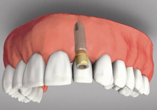 Lo lắng về việc cấy răng implant có đau không 2 