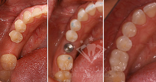 Trồng răng implant có đau không 3