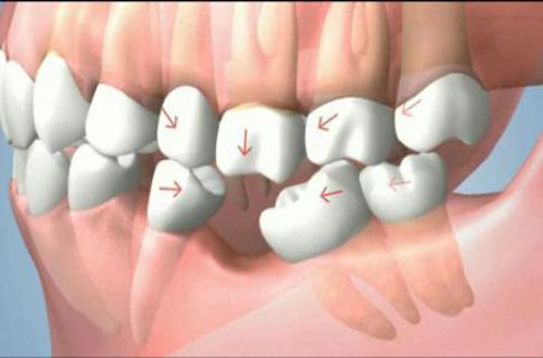 cắm răng Implant là gì 2