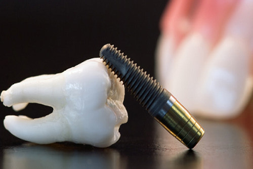ghép răng implant là gì
