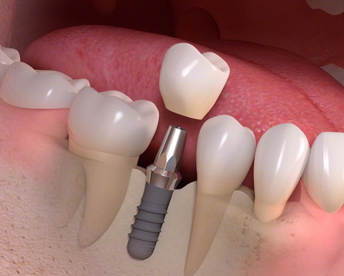 bảng giá răng implant