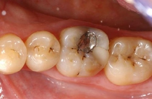 Trám răng sâu 2