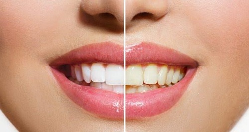 Lấy cao răng có làm trắng răng không