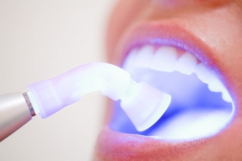 Lấy cao răng có làm trắng răng không 2