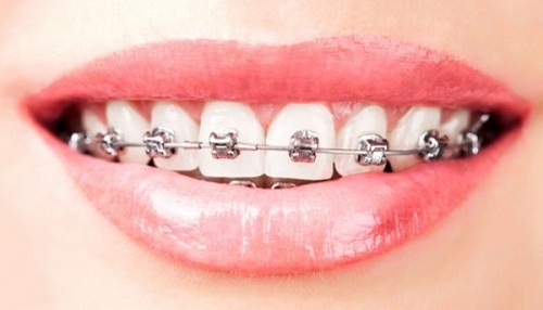Hô hàm có niềng răng được không 2