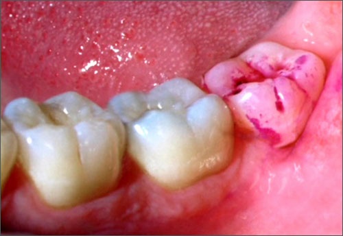 Răng khôn có mọc ở hàm trên không 2