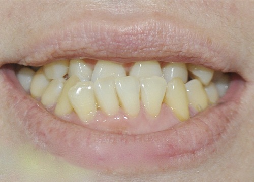 Răng móm là gì 