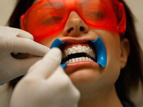 Quy trình lấy cao răng