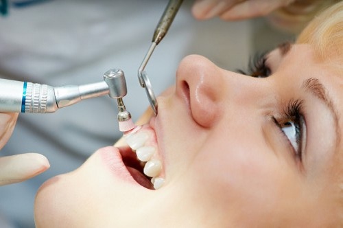 Quy trình lấy cao răng 2