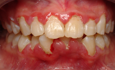 Bệnh viêm quanh răng là gì?