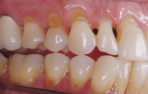 Triệu chứng khi bị nhức răng mòn men