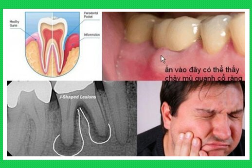 Tác hại của viêm quanh răng
