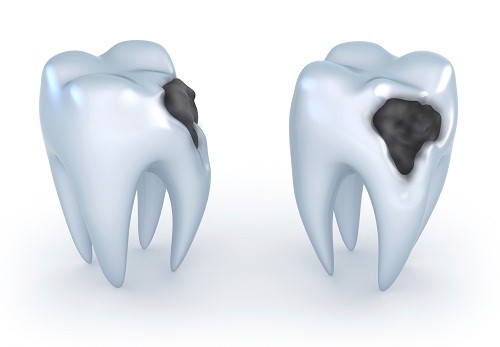 Giai đoạn 2 của viêm tủy răng