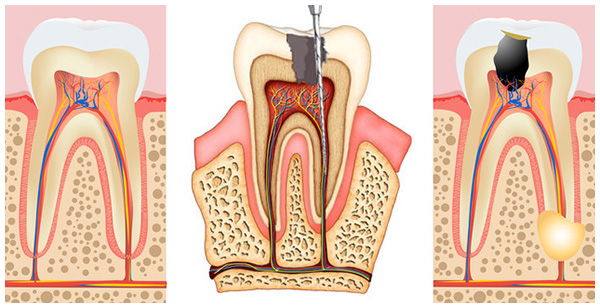 Giai đoạn 3 của viêm tủy răng
