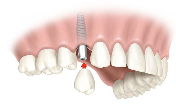 cấy ghép implant cho người mất nhiều răng