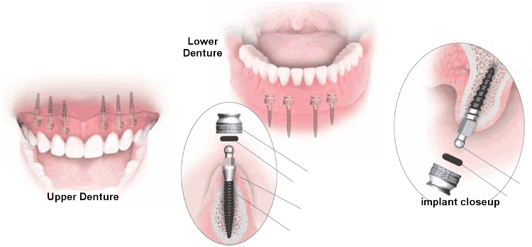 Cách tiết kiệm chi phí khi thực hiện cấy ghép răng Implant