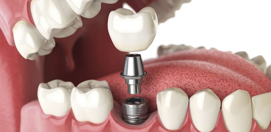 Trồng răng implant có tốt không?