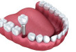 Chia sẻ kinh nghiệm: Có nên trồng răng Implant không?