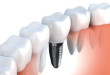 Địa chỉ ghép răng Implant ở đâu tốt? – Sự lựa chọn hoàn hảo cho bạn