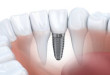 Chi phí làm răng implant giá bao nhiêu tiền là phù hợp nhất?