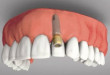 Bạn đang lo lắng về việc cấy răng implant có đau không?