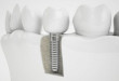 Cấy ghép răng sứ Implant và công nghệ hoàn hảo cho phục hình răng mất