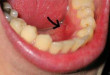 Tại sao răng có màu vàng – Nguyên nhân làm vàng răng