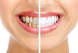 Lấy cao răng có tốt không? Câu trả lời từ bác sĩ nha khoa