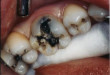 Hỏi đáp cùng chuyên gia: Răng hàm sâu có nên nhổ?