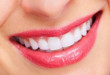 Giải đáp thắc mắc “tẩy trắng răng bằng laser” có tốt không?